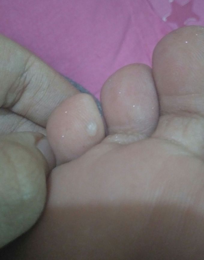 on backside of toe