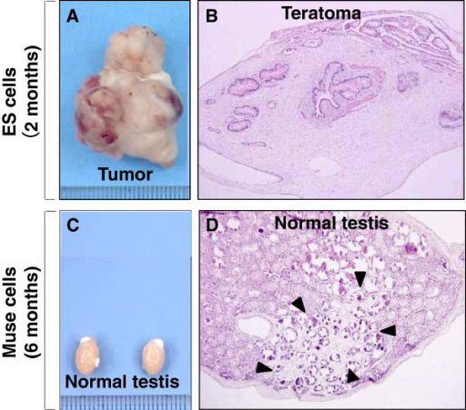 Testis Teratoma