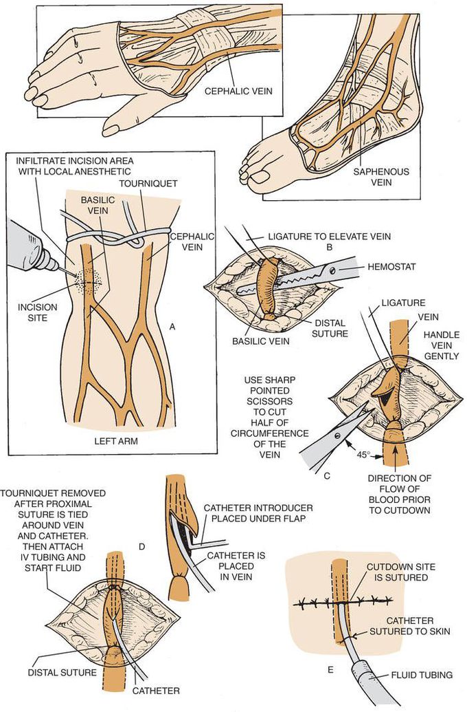 Steps of Venous Cutdown