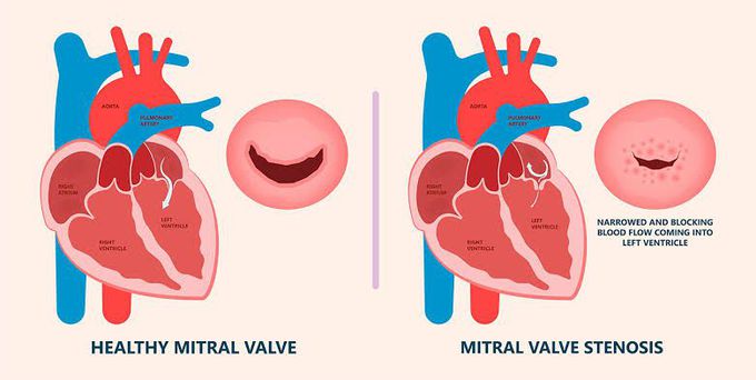 Mitral stenosis causes