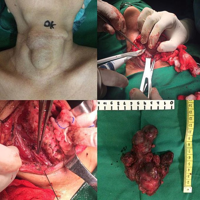 Thyroid cancer 