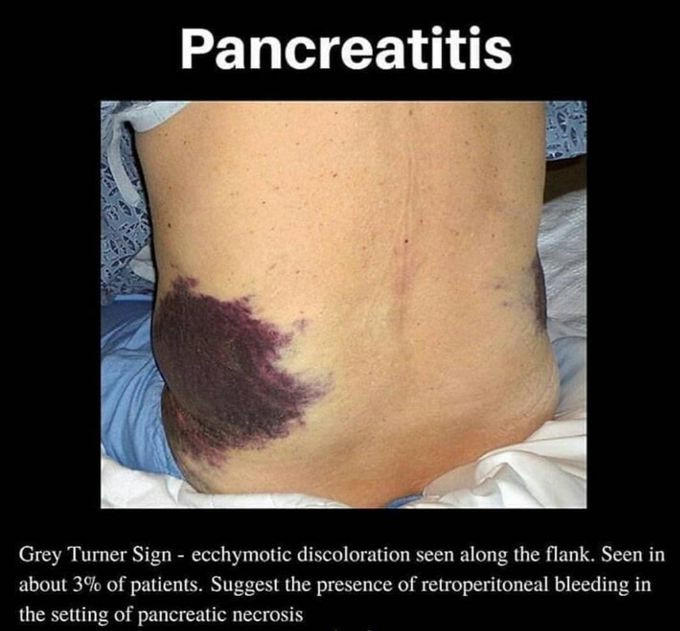 Pancreatitis