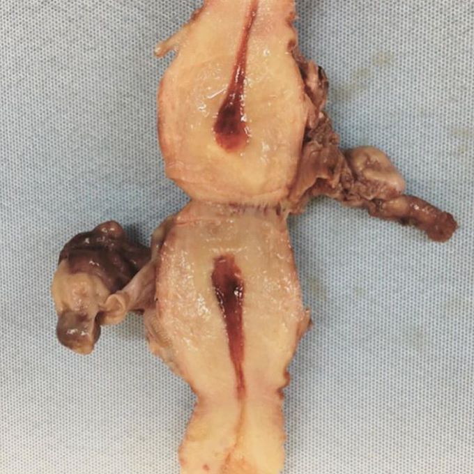 Uterus dissection