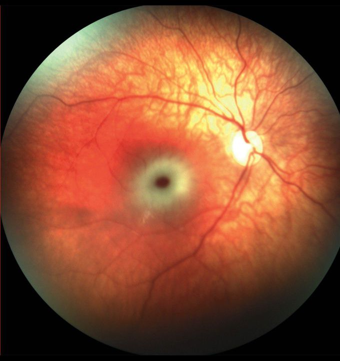 Cherry-Red Spot in Tay–Sachs Disease