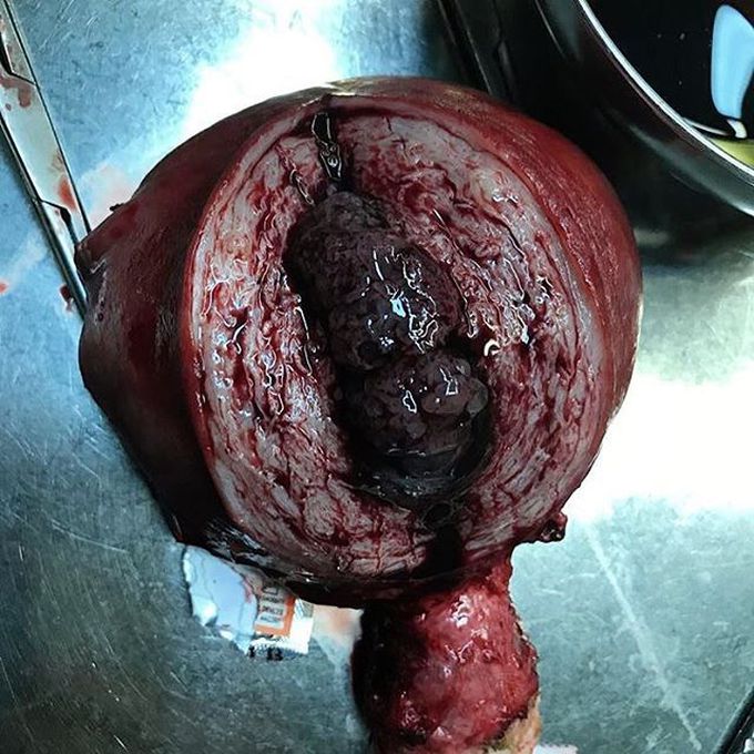 Hysterectomy for a molar pregnancy!
