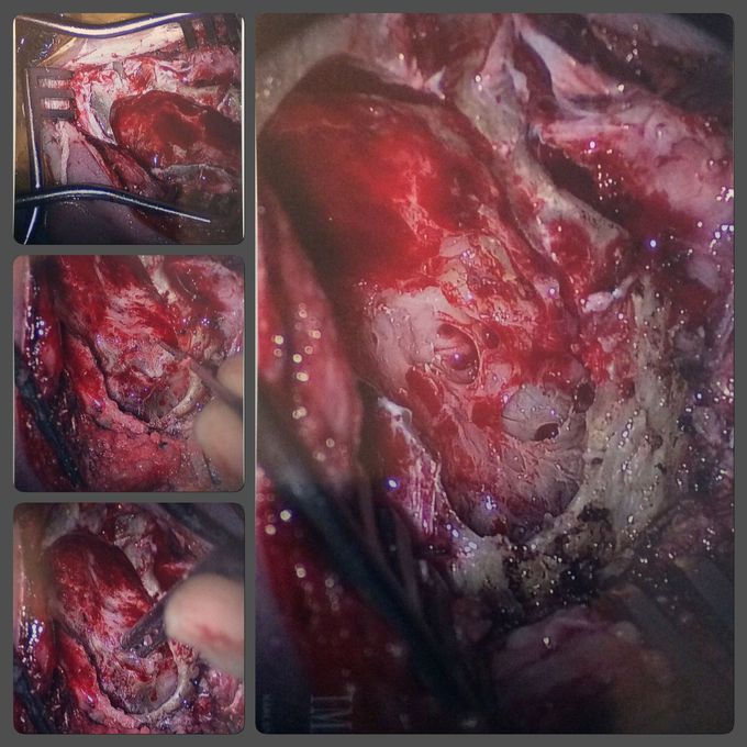 Mastoidectomy