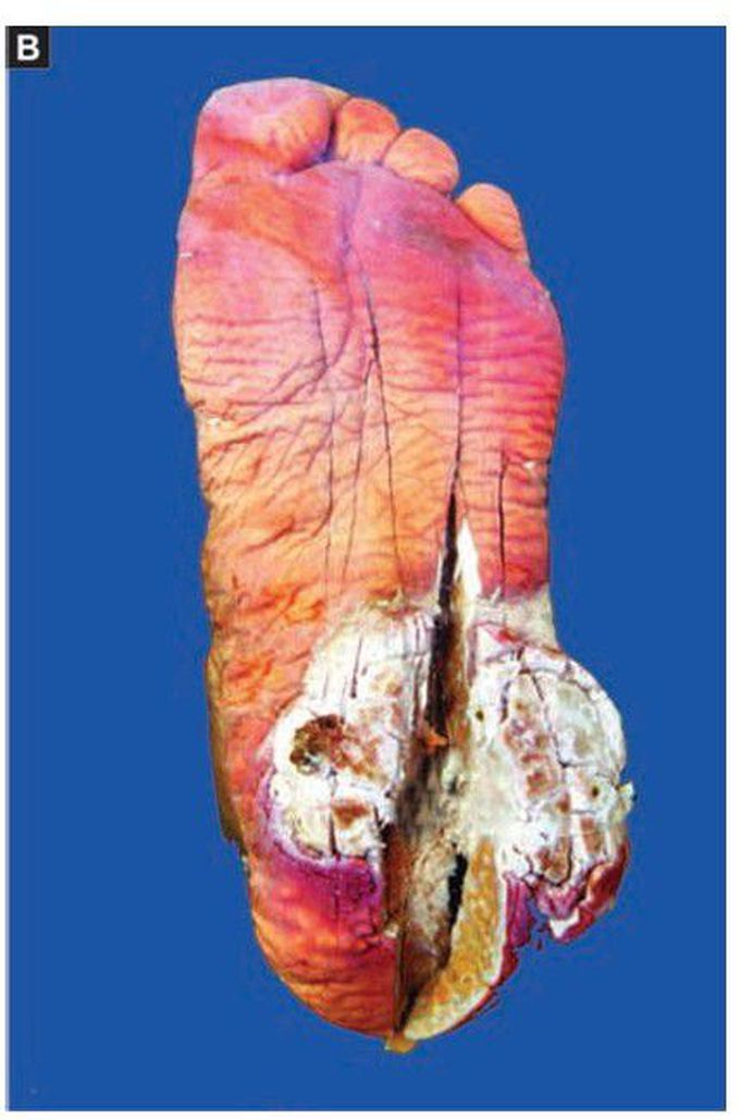 Squamous cell carcinoma