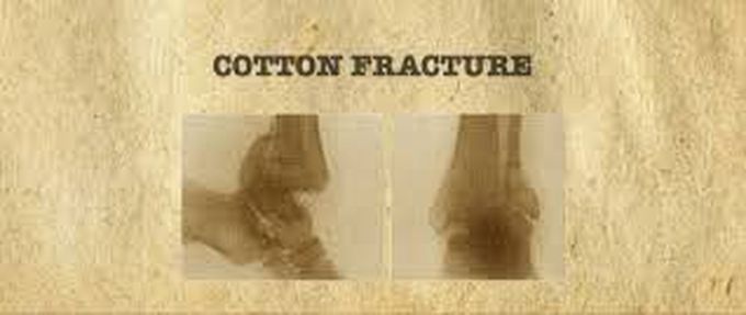 Cotton fracture
