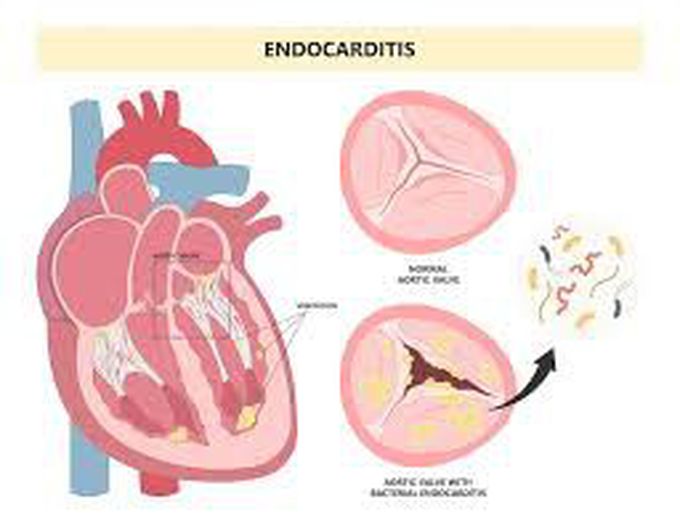 Signs of an endocarditis