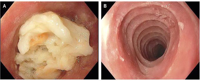 Trachealization” of the Esophagus
