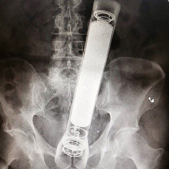 Foreign body in lower abdomen
