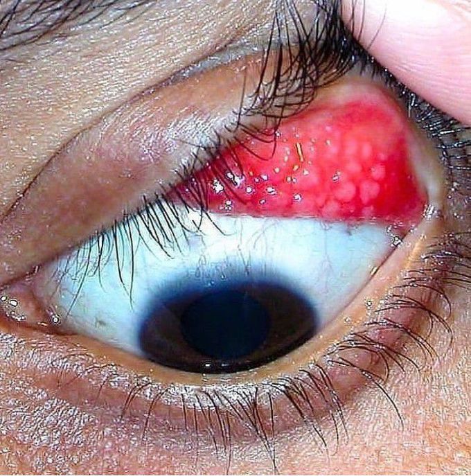 Vernal keratoconjunctivitis (VKC)