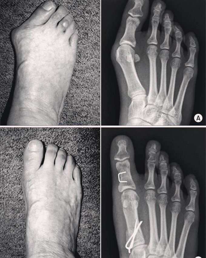 Hallux Valgus