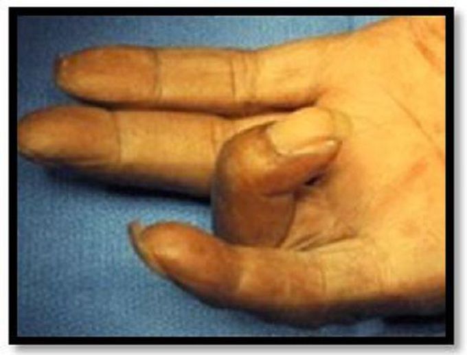 What's the name of this sign in RA?!! The patient does not have the ability to hit his hand