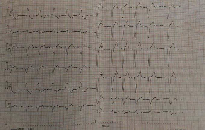 ECG