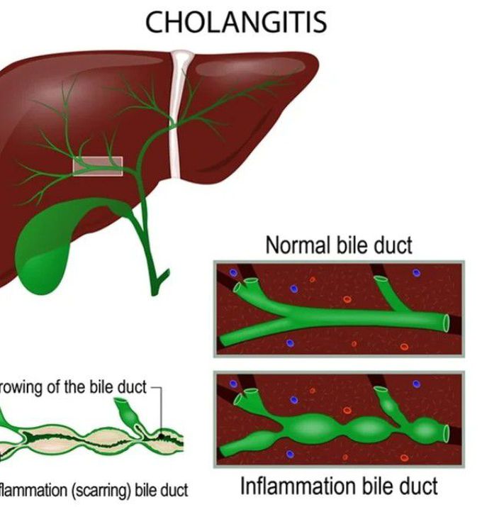 Cholangitis