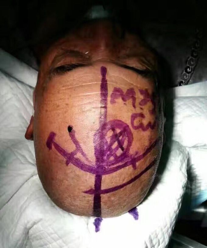 Neurosurgery