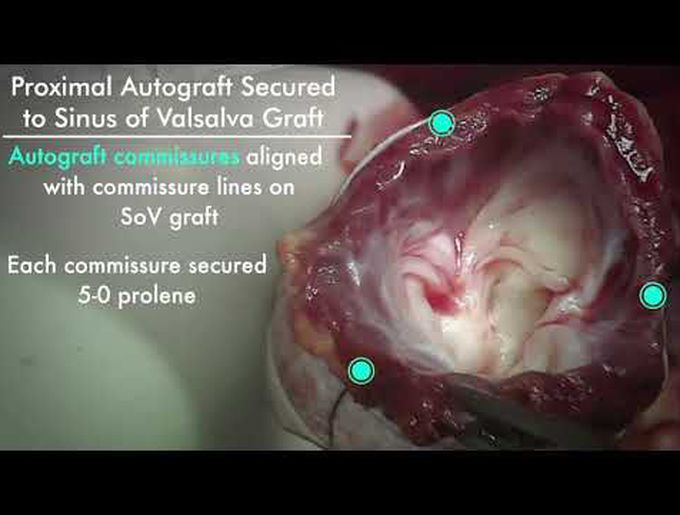 Externally-Supported Ross Procedure and Konno Aortoventriculoplasty With Sinus of Valsalva Graft