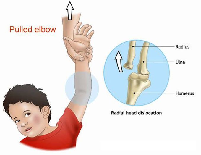 Nursemaid elbow