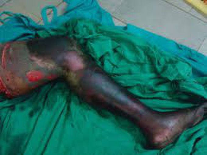 Gangrene