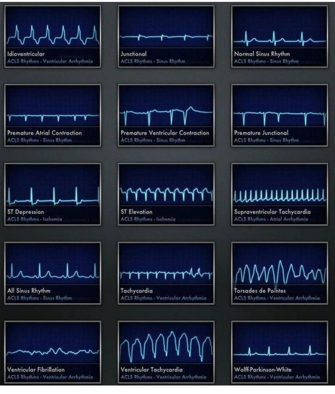 Common Cardiac Rhythms