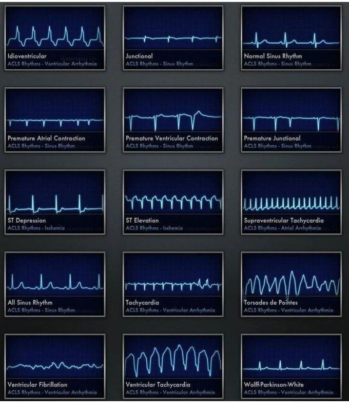Common Cardiac Rhythms