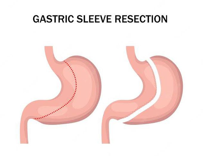 Gastric resection