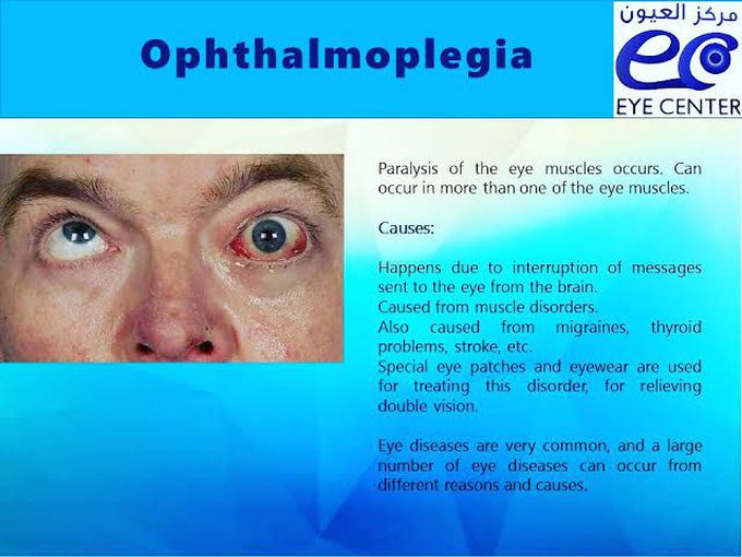 Opthalmoplegia