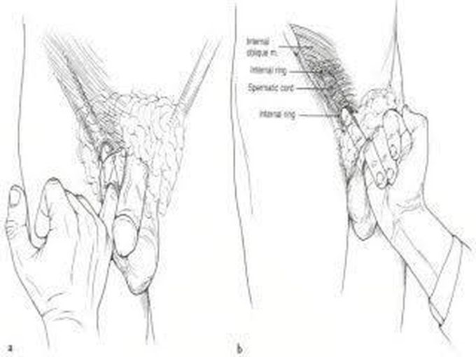 Ring occlusion test