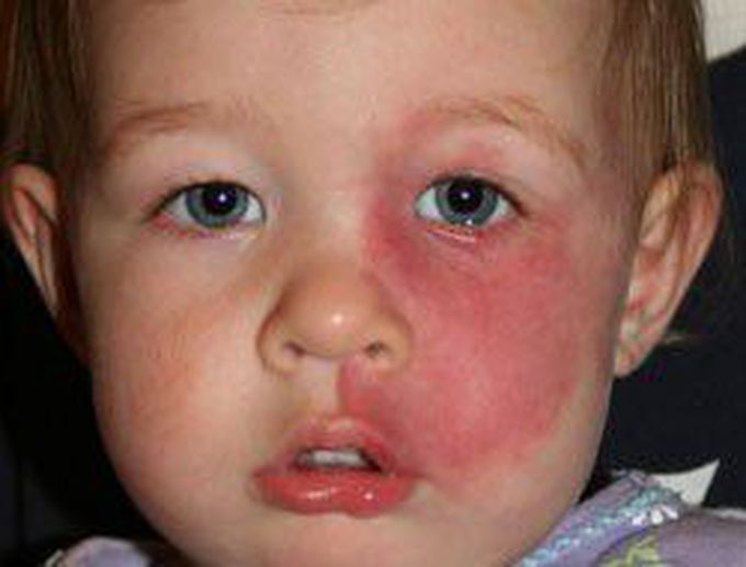 Sturge weber syndrome