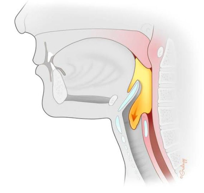 Treatment Of Dysphagia Medizzy