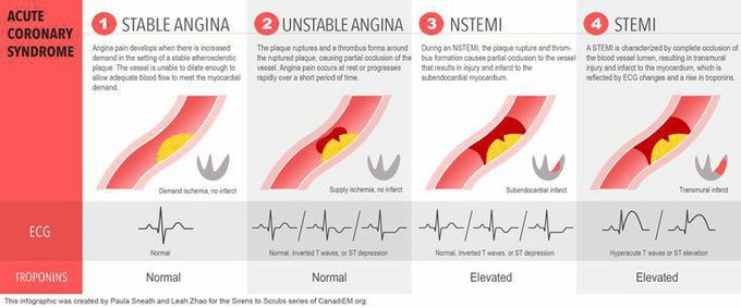 Stable Angina