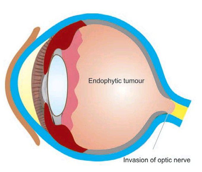 Retinoblastoma,