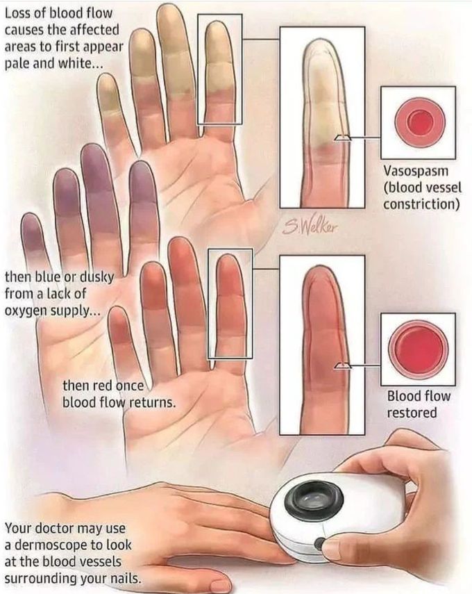 Raynaud's Phenomenon