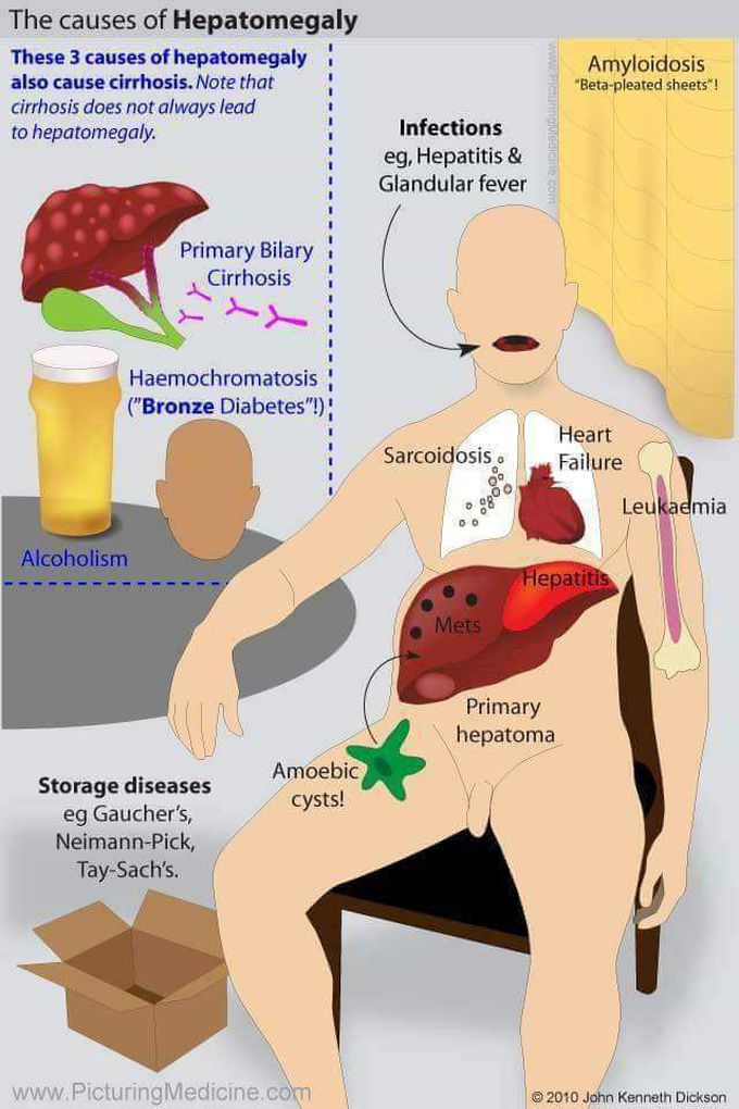 Causes of hepatomegaly