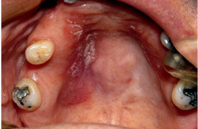 Acute pseudomembranous candidiasis