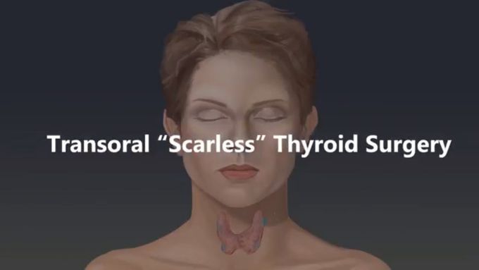 Transoral Thyroid Surgery- Made
Easy