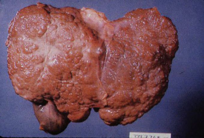 Liver cirrhosis
