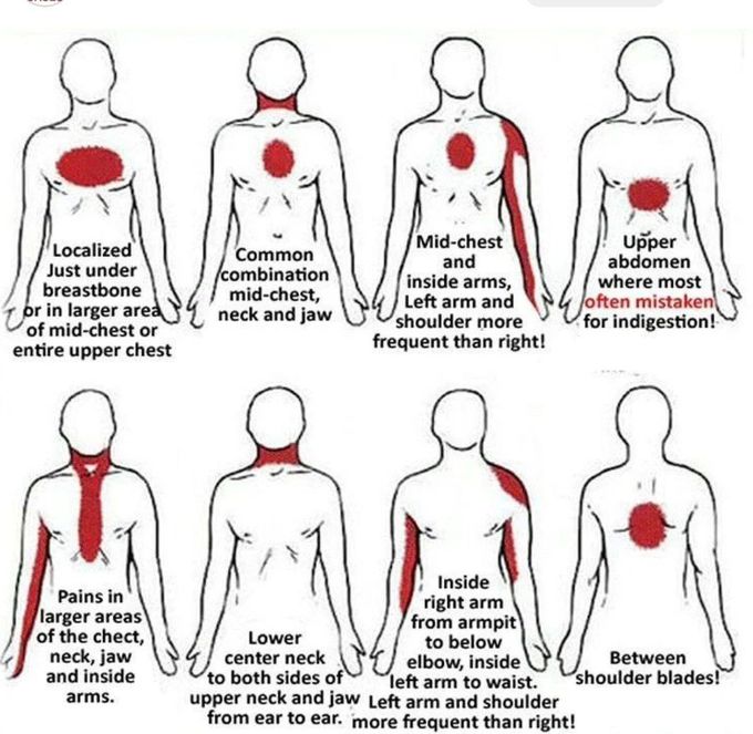 Heart Attack -Early Signs