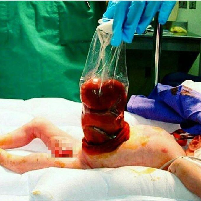 Gastroschisis