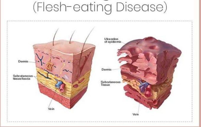 Necrotizing fasciitis