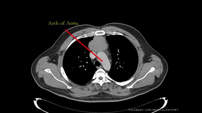 CT Thorax - How to Read