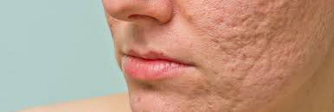 What causes acne scars?