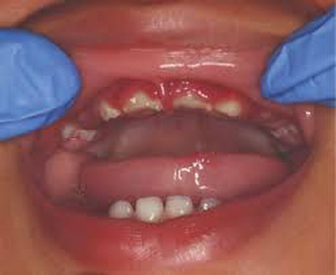 How to diagnoses gingivostomatitis?