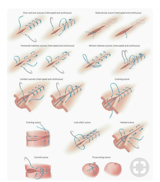 #stitches