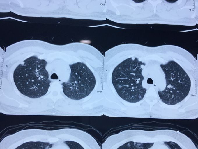 PROSTATE CANCER- METASTASIS (CT LUNG)