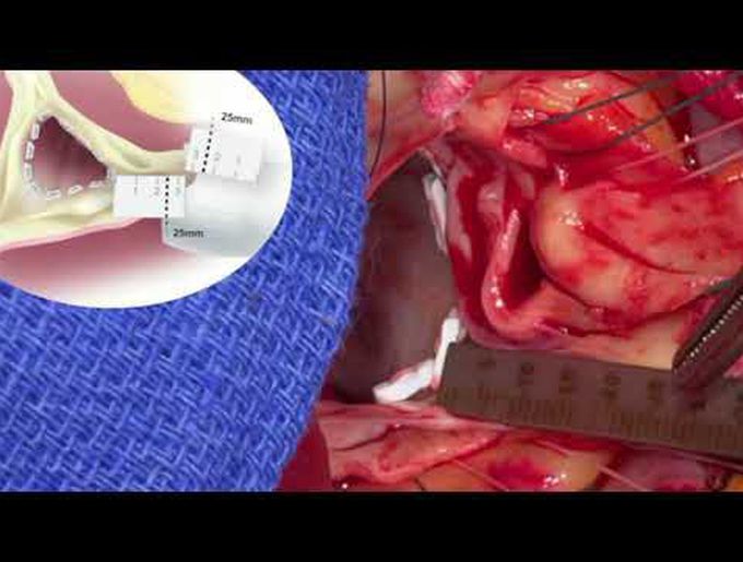 Minimally Invasive Valve Sparing Aortic Root Replacement in a Patient With Marfan Syndrome