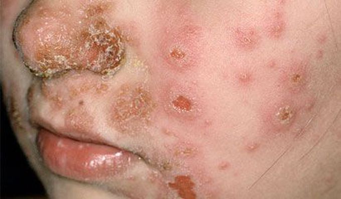Honey-colored crusts on the face in a patient with Impetigo