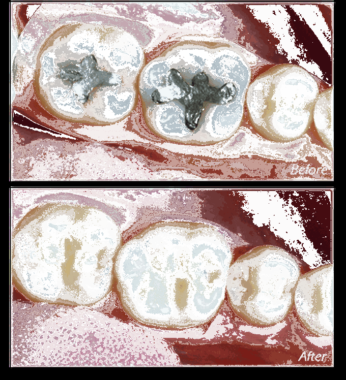 Amalgam vs composite filling