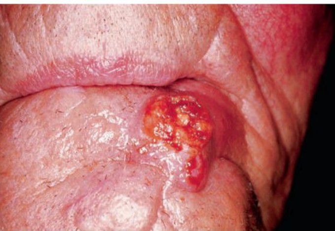 Squamous cell carcinoma of skin
